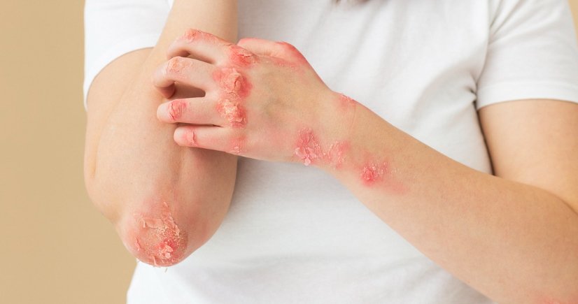 wart removal treatment​